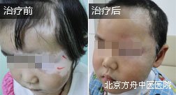 楚某眼部白癜风康复案例