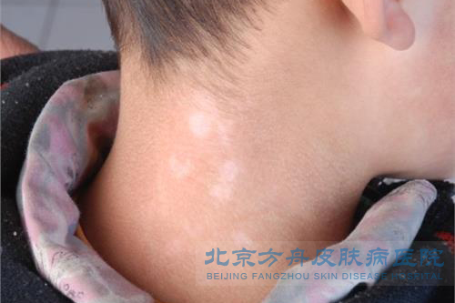 小孩得白癜风后应用什么方法治疗(图1)
