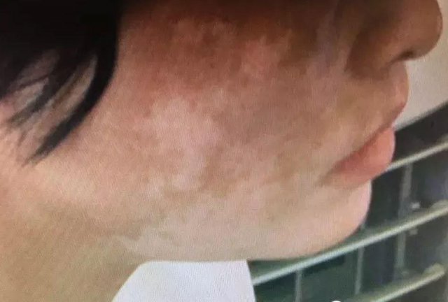 白斑患者要怎么使用化妆品?(图1)