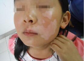 面部的白癜风可以预防吗?(图1)