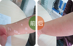 肢端型白癜风病因是什么呢?(图1)