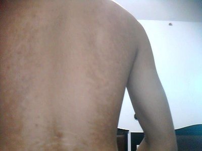 全身性白癜风该怎么办呢?(图1)
