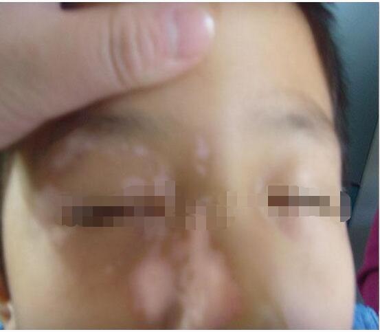 白癜风有什么危害?(图1)