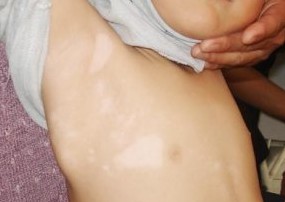 人们为什么会患上白癜风(图1)
