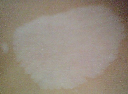 怎样能及早发现男性白癜风呢?(图1)