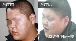 惠州方某脸部白癜风康复案例