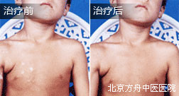 钱某胸部白癜风康复案例
