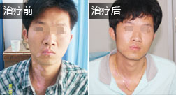 云南陈某颈部白癜风康复案例