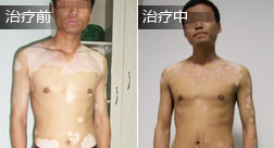 内蒙古皮某全身白癜风康复案例