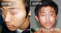 平顶山韦某眼部白癜风康复案例