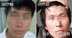 马某鼻部白癜风康复案例