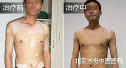 皮某上身白癜风康复案例