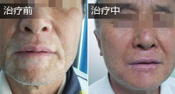朱某嘴部白癜风康复案例