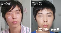 太原唐某脸部白癜风康复案例