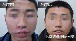 夏某面部白癜风康复案例