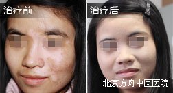 江苏施某脸部白癜风康复病例