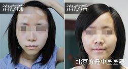 四川刘某脸部颈部白癜风康复病例
