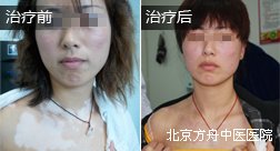 伊犁张某脸部白癜风康复案例