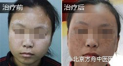 闫某面部白癜风康复案例