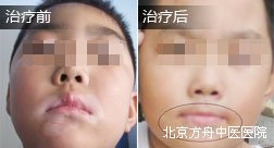刘某嘴部白癜风康复病例