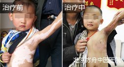 冉某上身白癜风康复案例