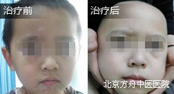 苏某嘴部白癜风康复案例