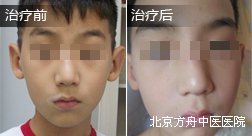 夏某嘴部白癜风康复案例