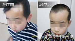 孙继堂额头白癜风康复病例