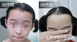 武某额头白癜风康复案例