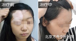 韩某额头白癜风康复案例