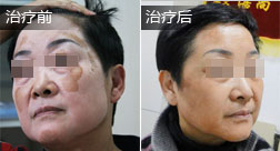 廖某脸部颈部白癜风患者康复案例