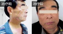 马某脸部白癜风康复案例