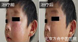 徐某脸部白癜风康复案例