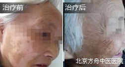 李某脸部白癜风康复案例