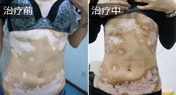张某上半身白癜风康复病例