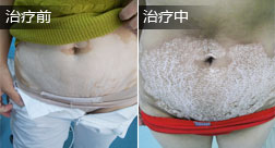 张某上半身白癜风康复病例