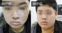 李某嘴部白癜风康复案例