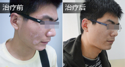 耿某脸部白癜风康复病例