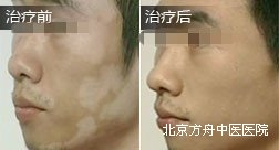 周某脸部白癜风康复案例