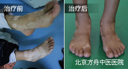 邵某脚部白癜风康复案例