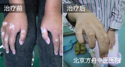 高某肢端型白癜风康复案例