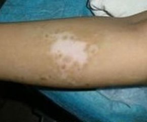 白癜风早期应该怎么诊断?(图1)