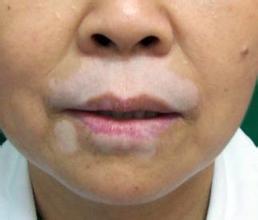夏季应该怎么预防白癜风疾病?(图1)