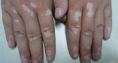 该怎么避免白癜风的恶化?(图1)
