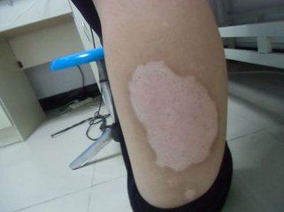 白癜风患者夏季应注意什么？(图1)