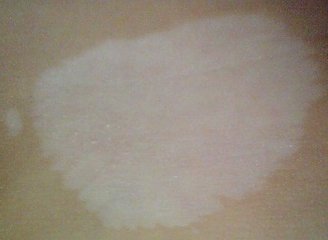 白癜风治疗的方法是什么呢?(图1)