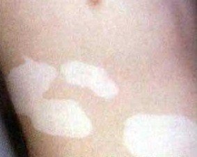 白癜风的原因究竟有哪些?(图1)