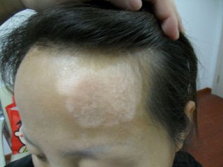 女性白癜风可以染发吗?(图1)