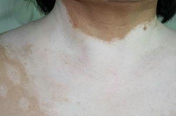 晚期颈部白癜风的症状是什么?(图1)