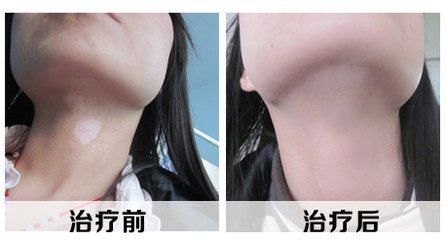 白癜风的症状特点具体有哪些?(图1)